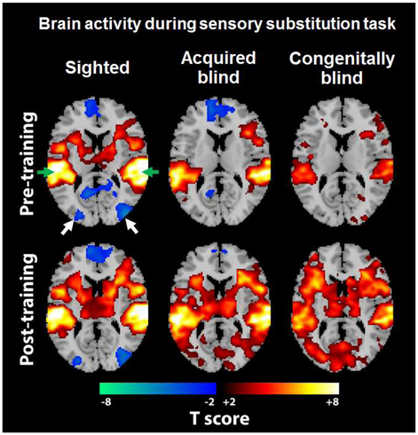 Fig 1. Functional MRI of brain activity during a sensory substitution task.

The colored overlays on the anatomical brain images are the blood-oxygenation-level-dependent (BOLD) activation maps in response to a visual-to-auditory sensory substitution task for sighted (left column), acquired blind (middle column), and congenitally blind adult subjects (right column) before (top row) and after 10 minutes of training (bottom row), indicating increased modulation of the occipital visual cortex in t…